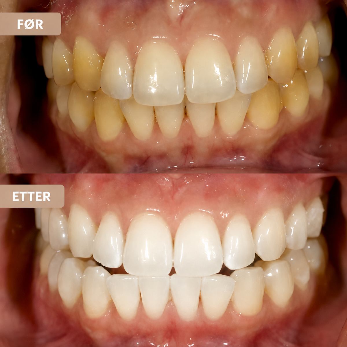 Whitening tannkrem – Reduser misfarging